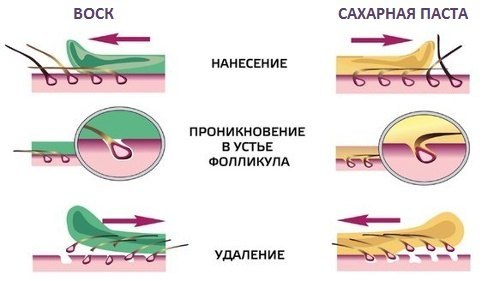 Сравнение техники проведения шугаринга и ваксинга