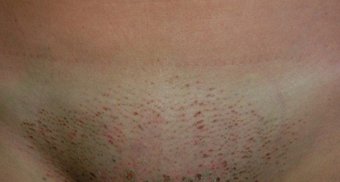 корочки на коже в период заживления кожи после электроэпиляции