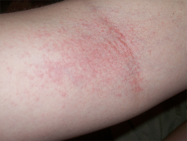 Аллергия на сгибе локтя
