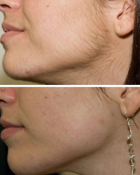 Шугаринг на лице: до и после