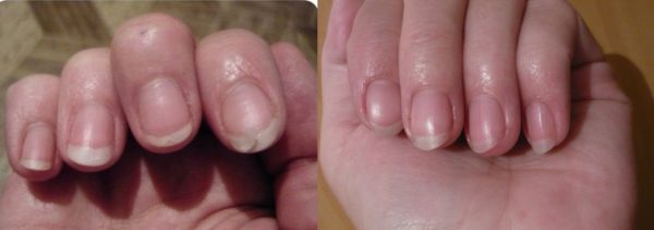 Вид ногтей до и после 2 недель приёма льняного масла
