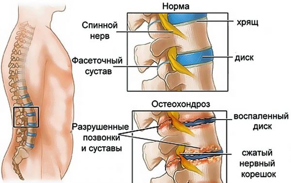 Рисунок этапов развития остеохондроза