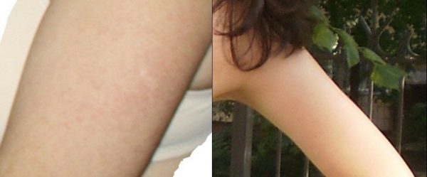 Пигментированность кожи до и после применения мандаринового масла