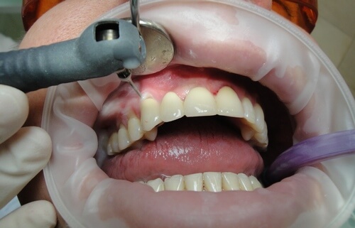 Процесс снятия зубных отложений Вектором