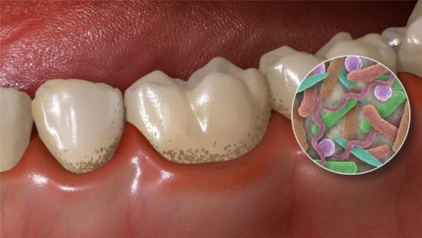 Бактериальный зубной налёт