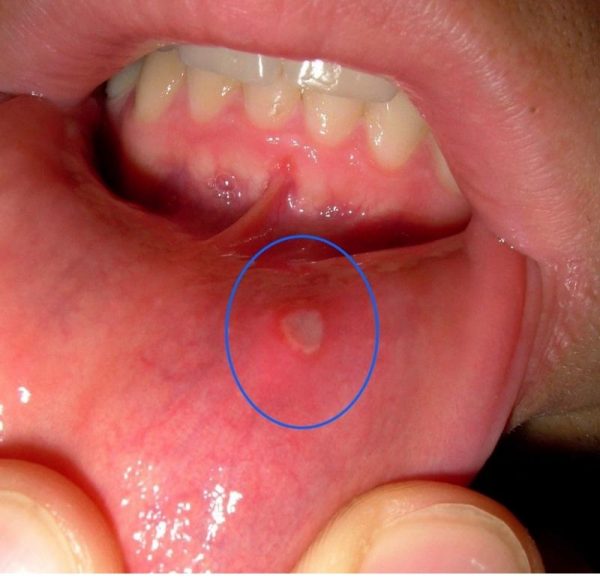 Стоматическая язва на губе