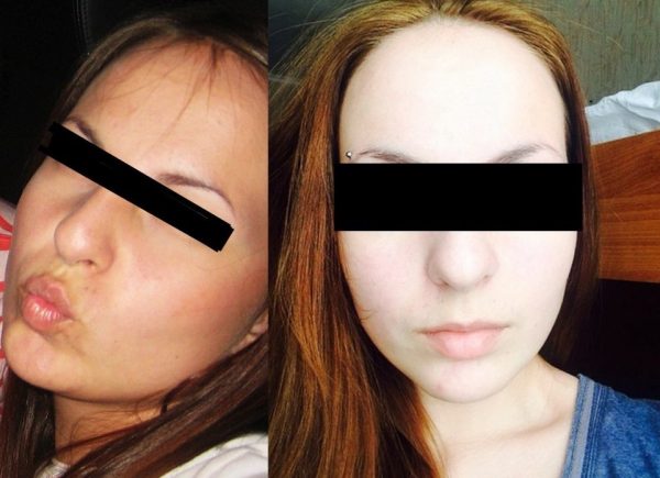 Кожа на лице девушки до и после применения персикового масла (в течение полутора месяцев)