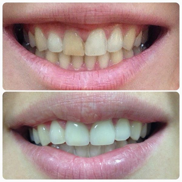 Отбеливание зубов (до и после)
