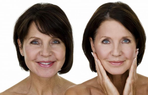 Плазмолифтинг лица — до и после