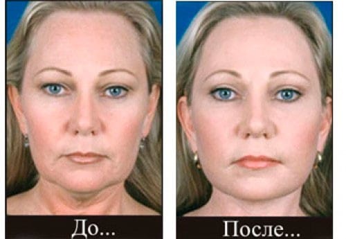 Лицо до и после дермотонии