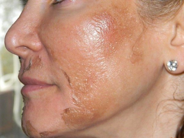 Интенсивное шелушение кожи после пилинга