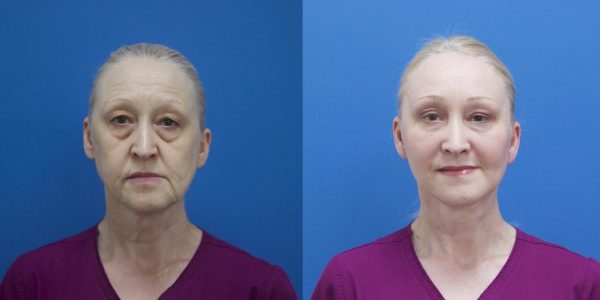 Пластическая операция по подтяжке лица: до и после