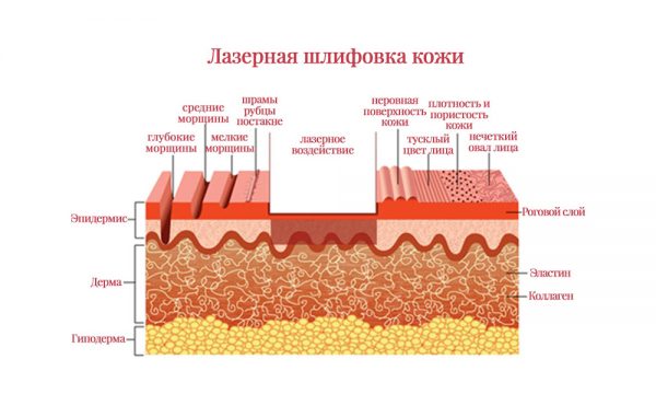Схема лазерной шлифовки кожи