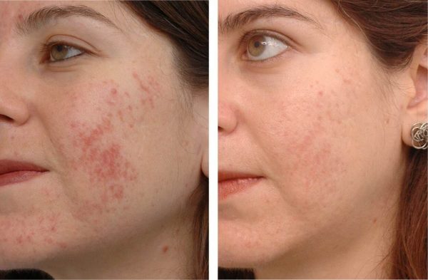 До и после курса масок с мумиё при проблемной коже