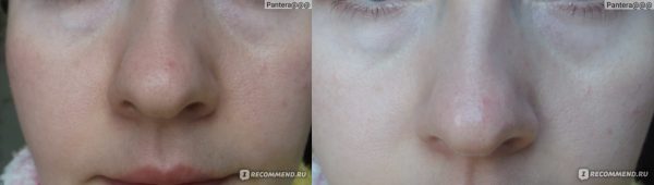 Фото лица до и после применения яичной маски