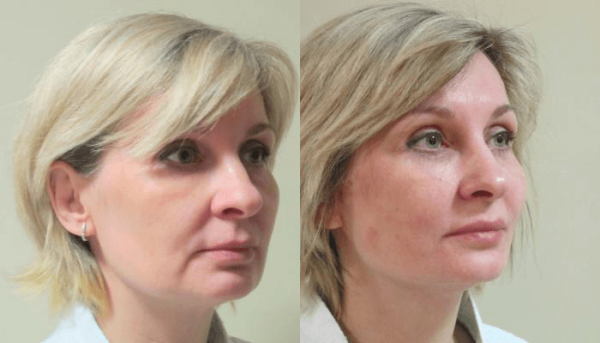 Фото лица до и после нитевого лифтинга