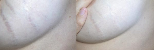 Растяжки на груди до и после применения геля Медерма