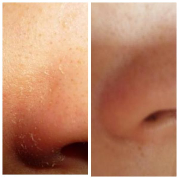 Кожа возле носа девушки до и после использования ретинола ацетата