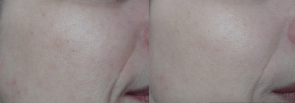 Лицо до и после нанесения тонального крема