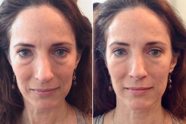 Лицо до и после лимфодренажного массажа