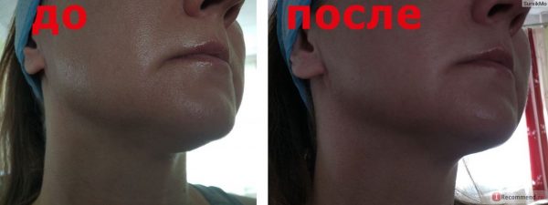 Фото подбородка до и после вакуумного массажа