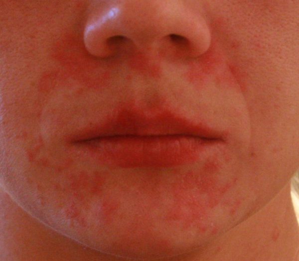 Проявление аллергической реакции на лице