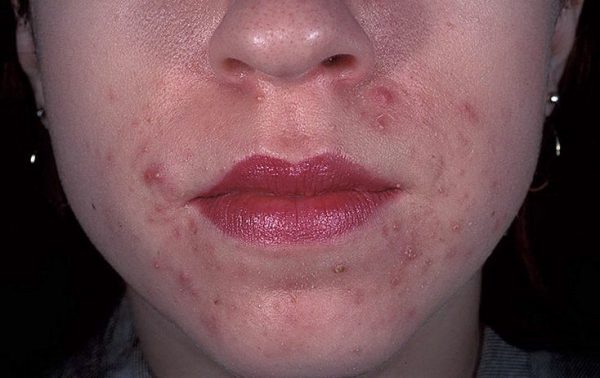 Пример аллергии на лице