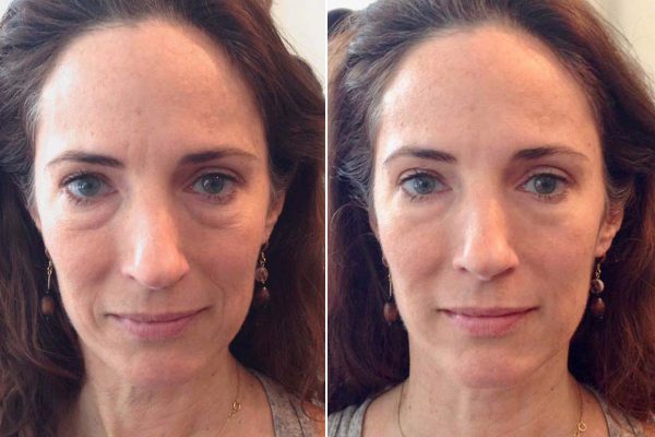 Фото лица до и после массажа