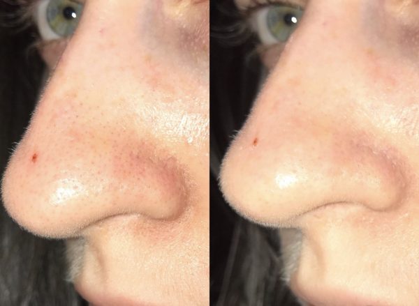 До и после применения Holy Land Cosmetics Special Mask для лица