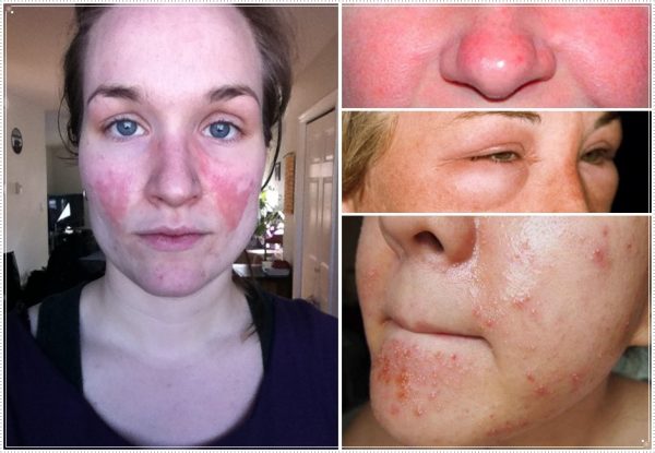 Примеры аллергических реакций на лице
