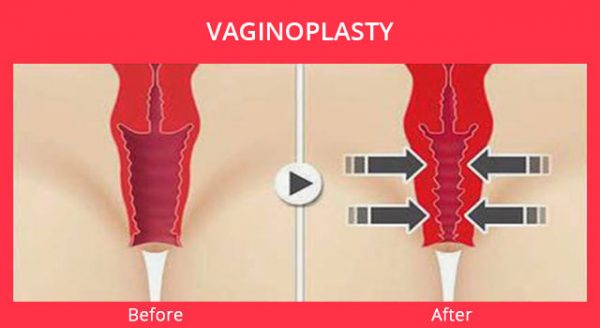 До и после вагинопластики