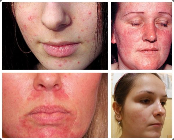 Примеры аллергических реакций на лице