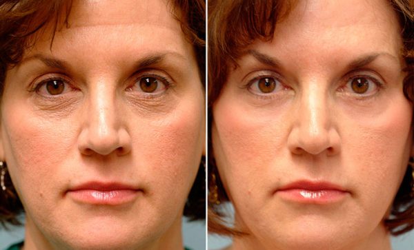 Женское лицо до и после омоложения с помощью мезококтейля