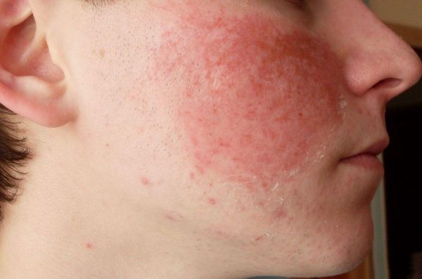 Заболевание атопический дерматит на лице