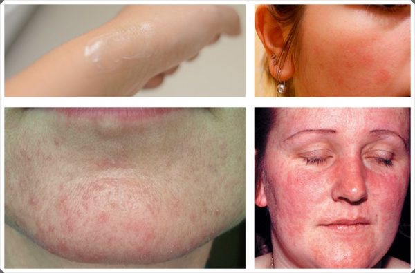 Аллерготест и примеры аллергических реакций на лице