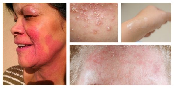 Примеры аллергических реакций на лице, проверка маски на аллергенность