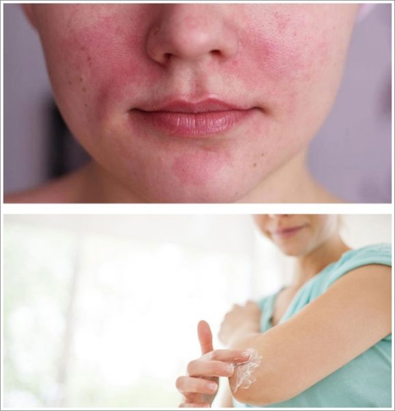 Раздражение кожи лица, тест на аллергическую реакцию