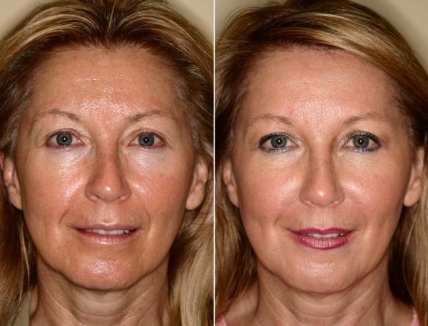 Фото лица до и после домашних лифтинг-процедур