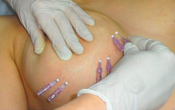 Процедура введения мезонитей в грудь