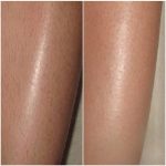 Ноги до и после лазерной эпиляции