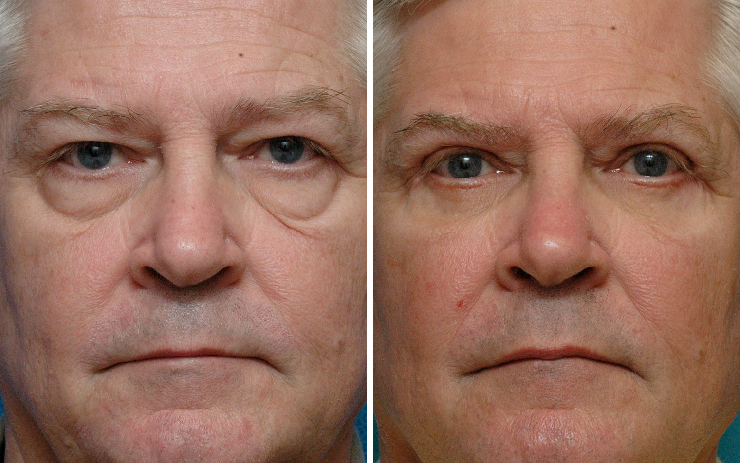 Блефаропластика мужчин фото до и после