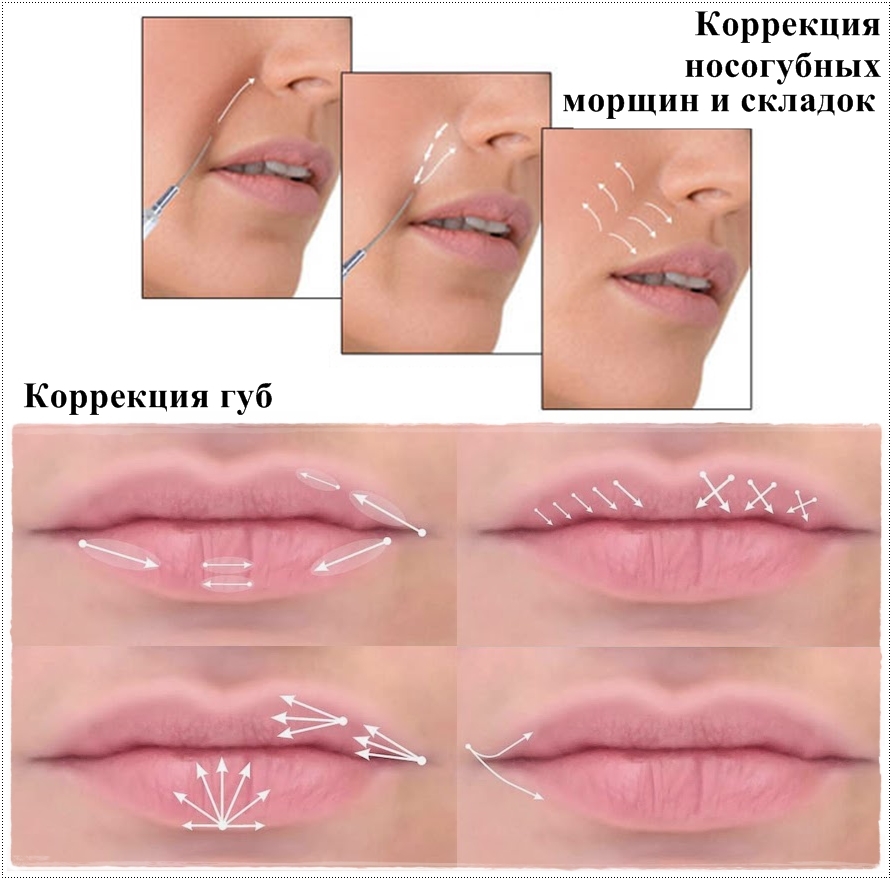 Сделать форму губ. Техники введения филлеров в губы. Техники коррекции губ филлерами. Техника увеличения губ филлерами. Схема коррекции губ.