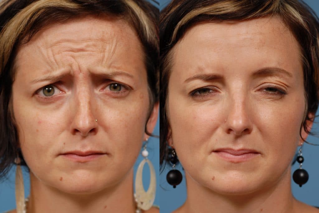Что можно делать после. Морщины до после. Ботокс для лица до и после. Ботулотоксин лица до и после. Ботокс лица до и после эффект.