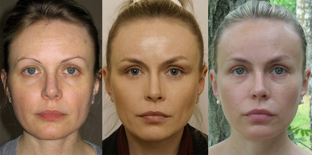 Пластика средней трети лица фото до и после